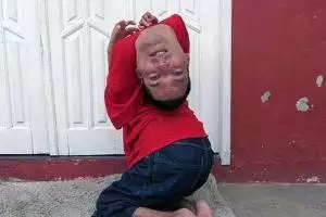 Мужчина, родившийся с перевернутой головой, выжил несмотря на прогнозы врачей